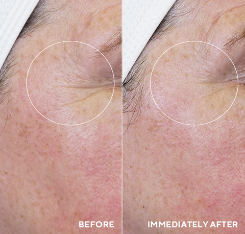 HydroPeptide Daily Drench Before and After