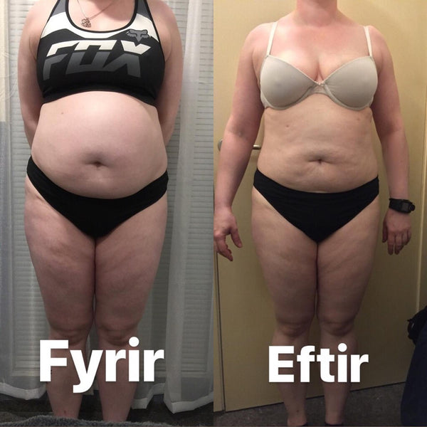 before and after totally laser lipo and fitform