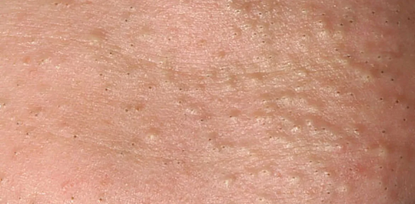 Comedonal Acne