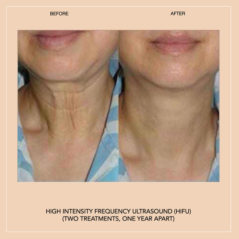 High Intensity Focused Ultrasound Ultherapy Lissom