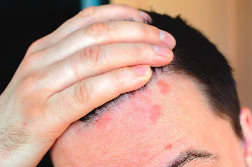Scalp Fungus Here is What You Can Do About It  AHS UAE