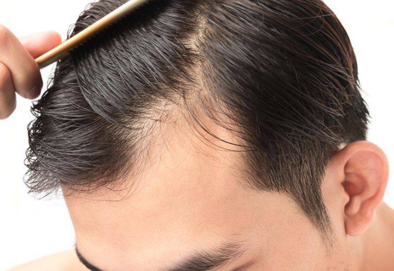 Low dose MINOXIDIL for hair thinning  what you need to know  Flora Kim  Dermatology