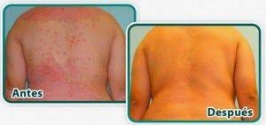 psoriasis antes despues