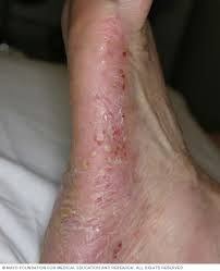 psoriasis postulosa