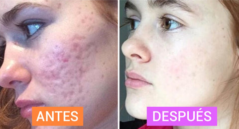 fenogreco para tratar el acne