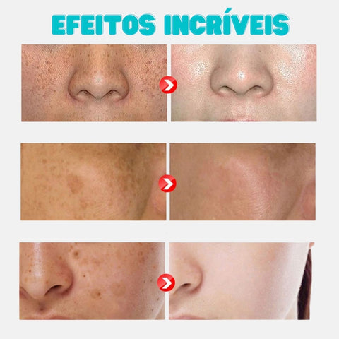 creme para melasma, melasma, creme para manchas, clarear manchas na pele, cuidados com a pele, skin care, skincare, cosméticos faciais, creme clareador, creme anti manchas