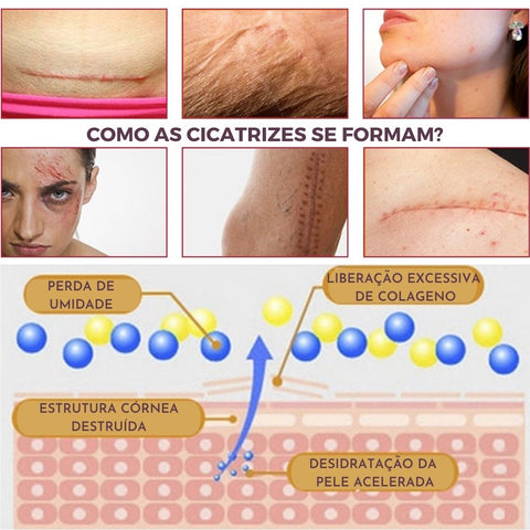 remover cicatriz, remover manchas, anti acne, remover marcas, pele perfeita, skin care, anti rugas, colágeno, cicatriz, manchas, melasma, rugas, acne, cravos, anti cravos, secativo de espinhas, cuidados com a pele