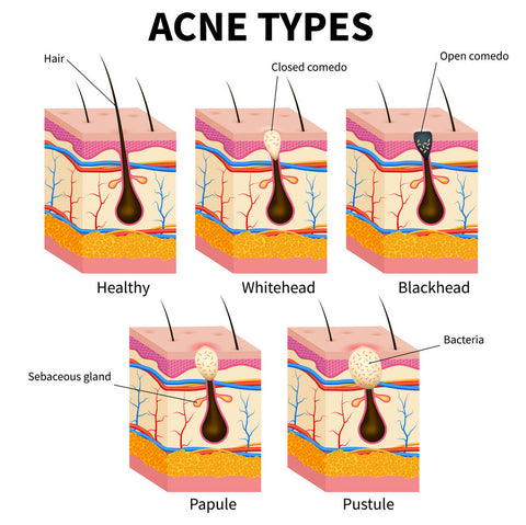 acne type, acne treatment