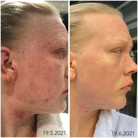 TSW paranee sykleittäin ja tässä näkee, kuinka suuri muutos ihossa voi tapahtua kuukauden aikana.