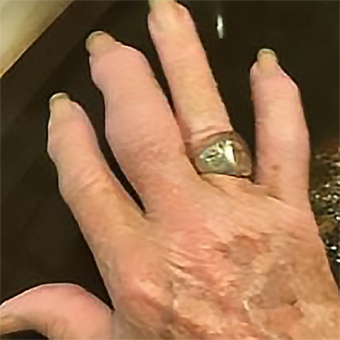 Picture of Professional Guitarist's hand and how much the swelling has gone down in relation to the before picture