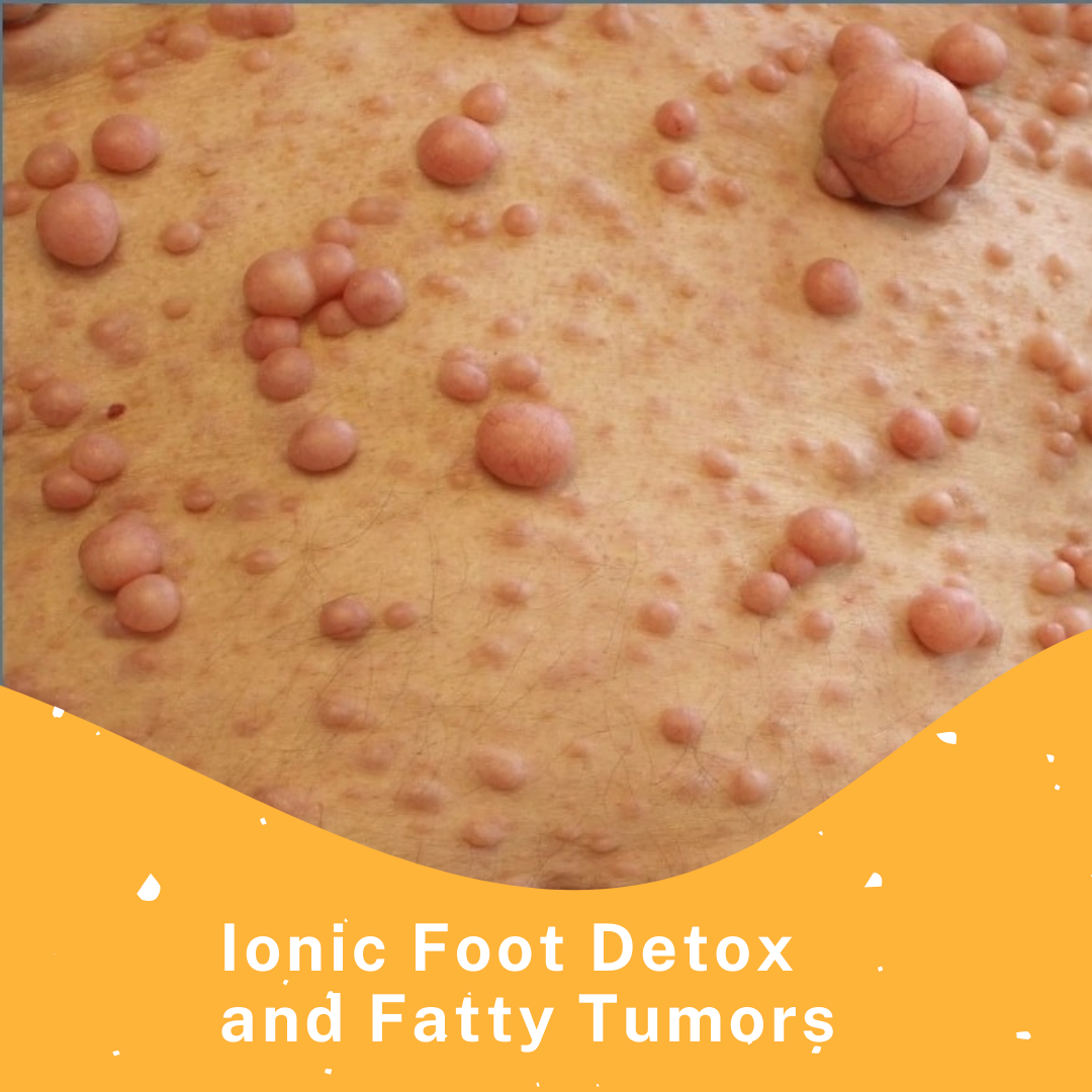 persons skin with a lot of fatty tumors