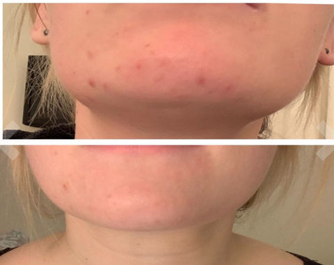 LED Light Therapy Facial Mask Results