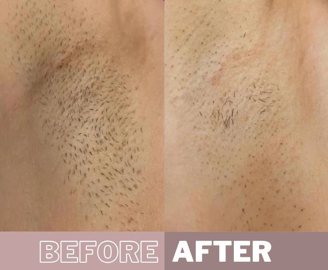 My Smooth Skin IPL before & after