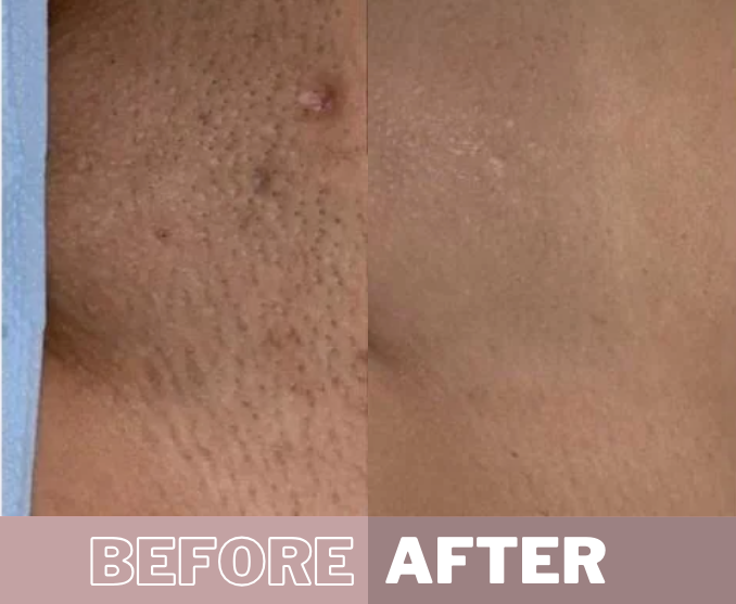 My Smooth Skin IPL before & after