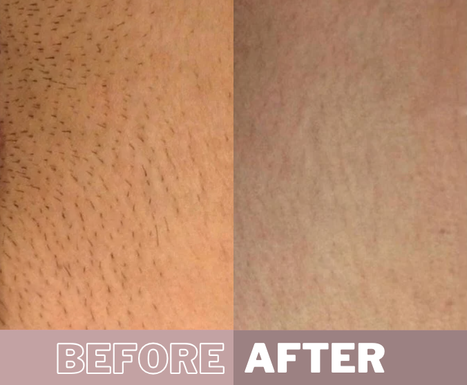 My Smooth Skin IPL before & after