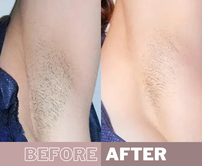 My Smooth Skin IPL before & after