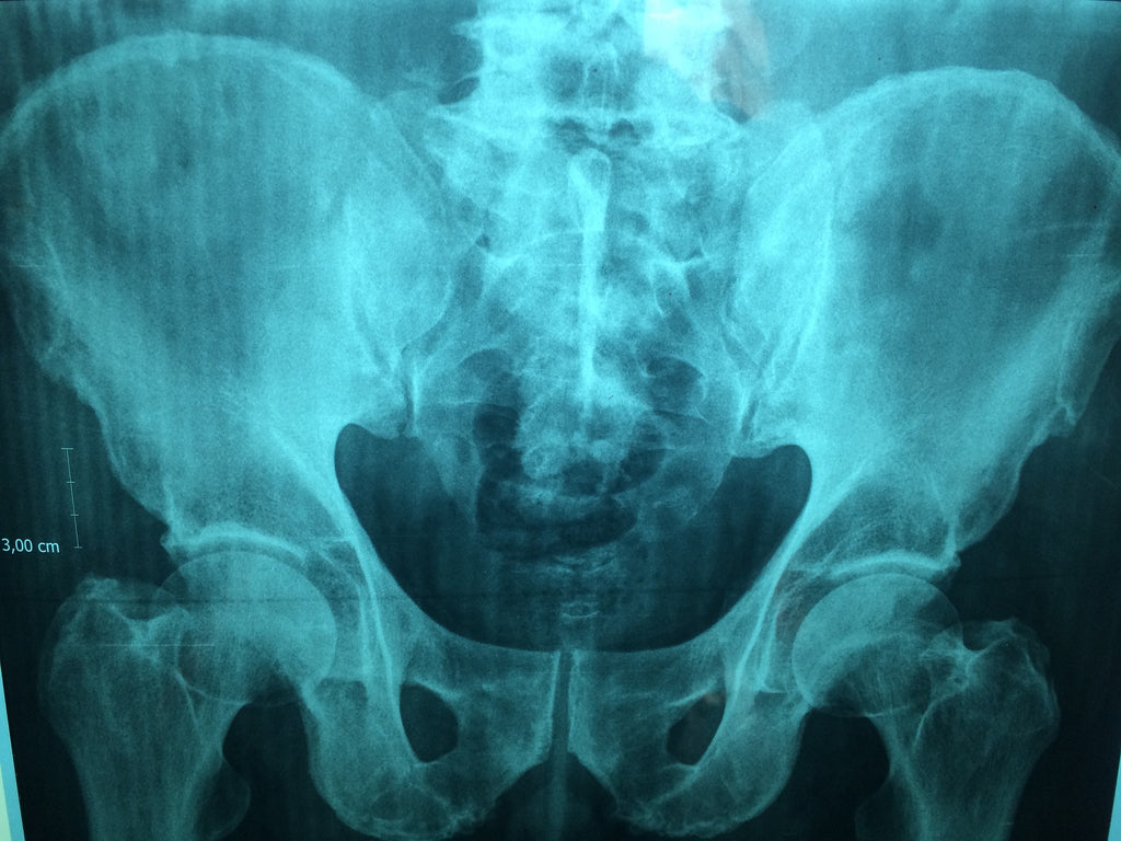 pelvix x-ray urinary pain