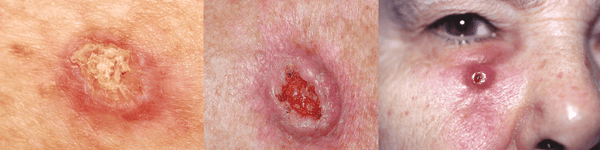 Pictures of Squamous Cell Carcinoma (SCC)