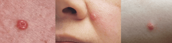 Pictures of Basal Cell Carcinoma (BCC)