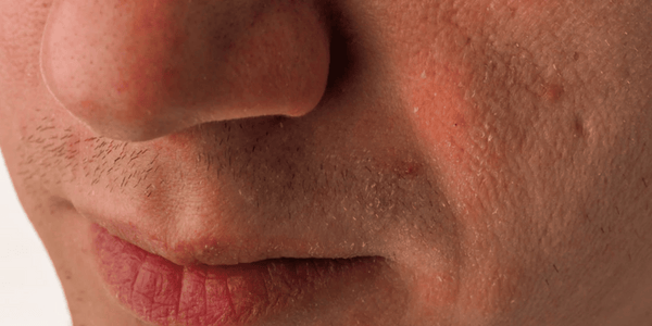 Men's Dry Skin: Typical Dry Skin