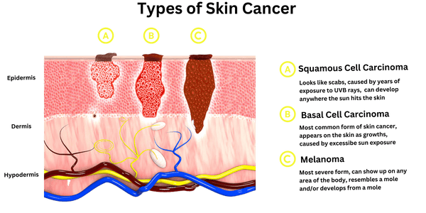 Different Type of Skin Cancer in Men