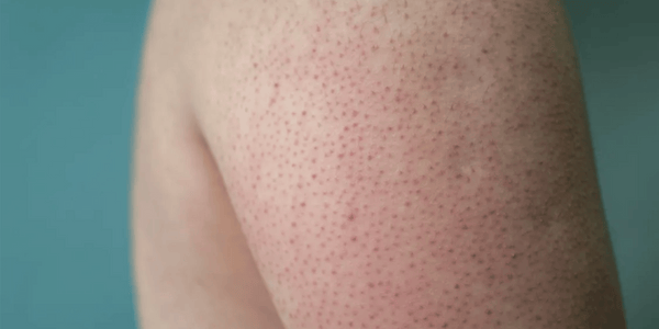 Keratosis Pilaris and Men's Dry Skin
