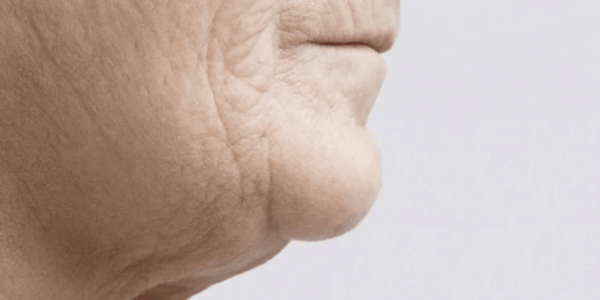 Slack or Loose Skin | Aging Skin Changes