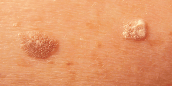 Skin Lesions | Aging Skin Changes