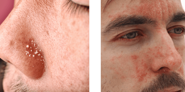Men's Dry Skin and Acne