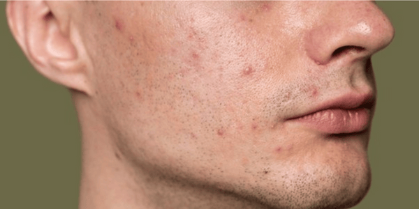 Is Oily Skin Bad for You? Enlarged Pores and Acne