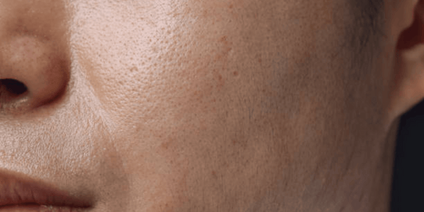 Enlarged Pores and Oily Skin