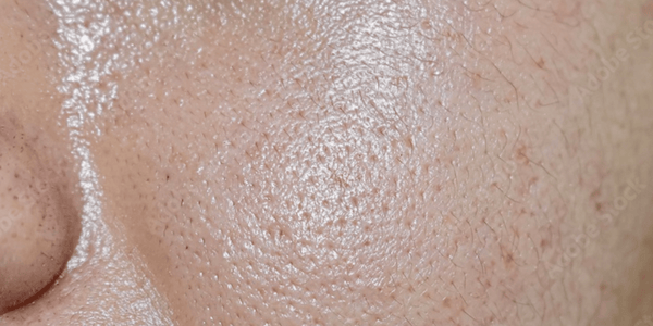 Close Up of Enlarged Pores and Oily Skin