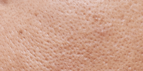 Enlarged Pores and Oily Skin