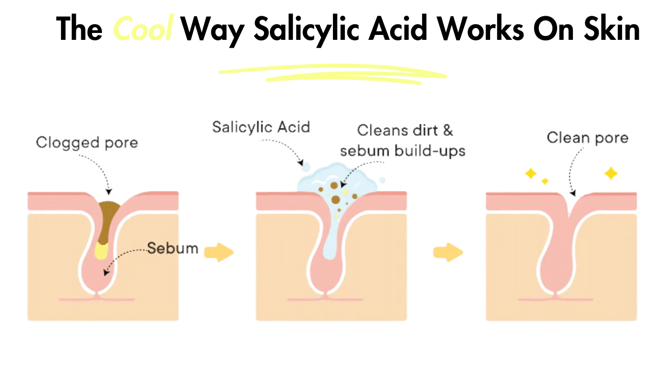 Is Salicylic Acid Good For Oily Skin? Photo Contains: Diagrams Showing How Salicylic Acid Works In Your Skin