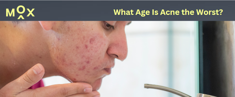 What age is acne the worst? A man washing his face.