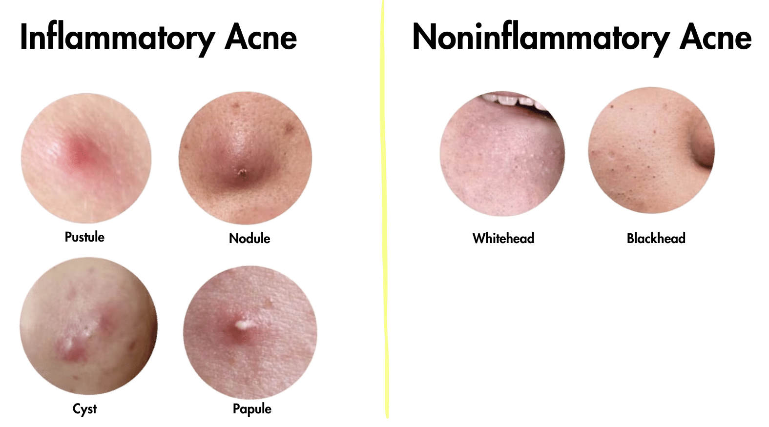 What age is acne the worst? The difference between inflammatory and noninflammatory acne.