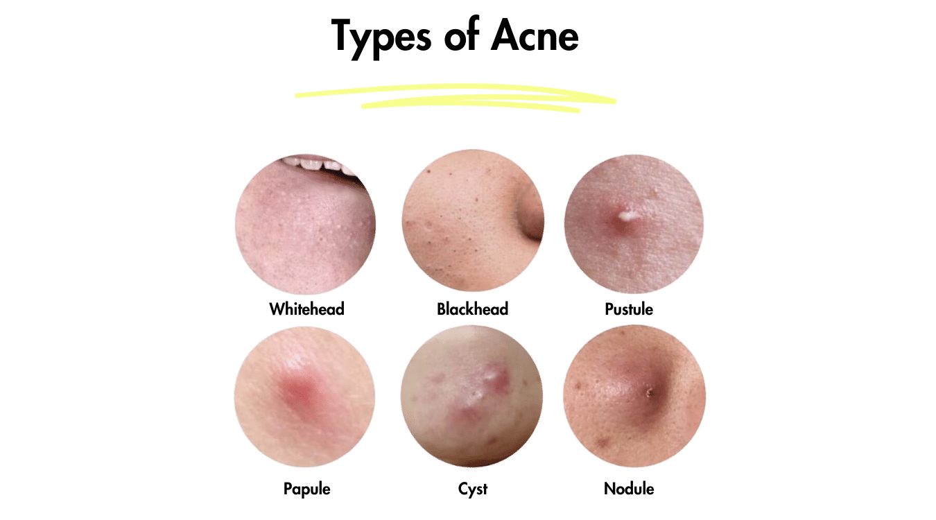 What age is acne the worst? The six types of acne lesions.