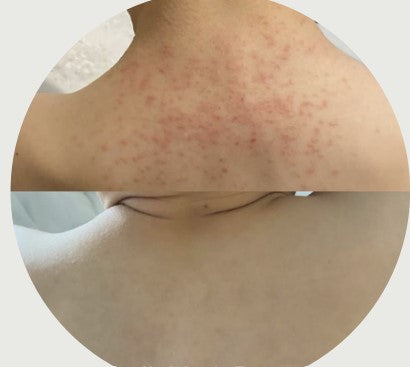 What can help with eczema