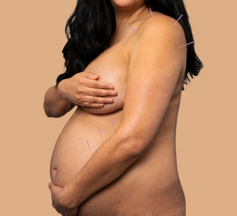 pregnant mama belly with acupuncture needles