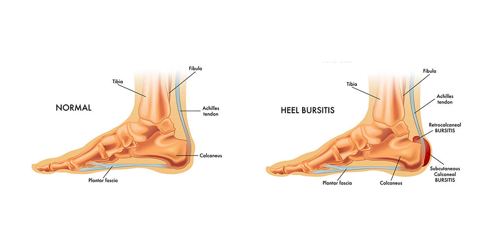 Retrocalcaneal Bursitis (Heel Bursitis)