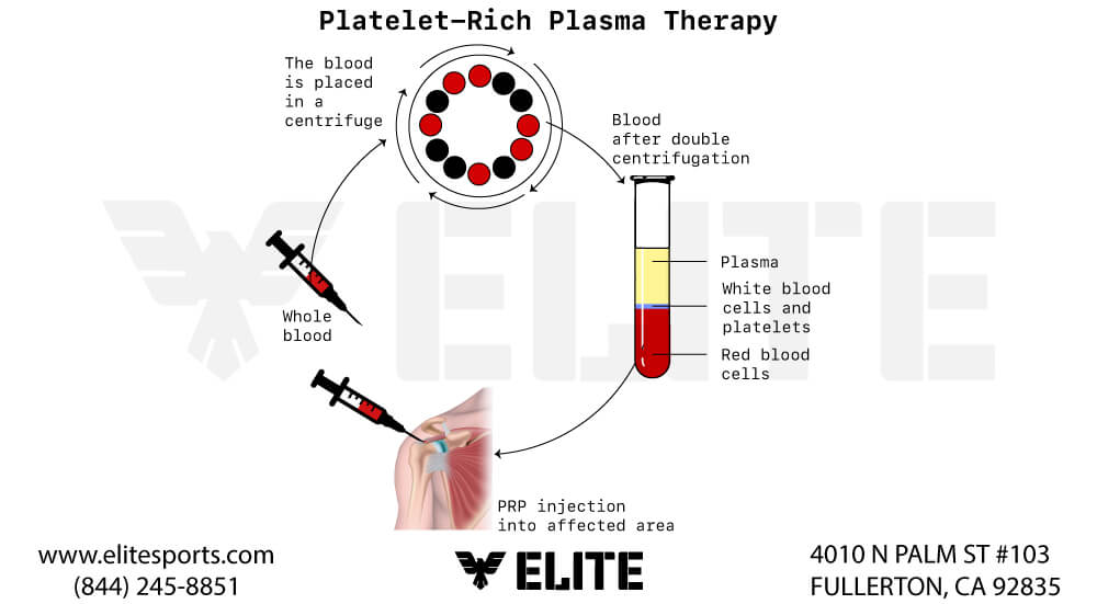 PRP – Platelet Rich Plasma Therapy