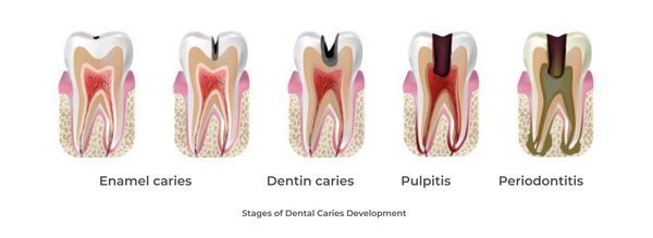 Stages of Dental Caries Development