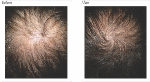 Hair Loss before and after