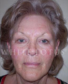 Wrinkles and Sun Damage After