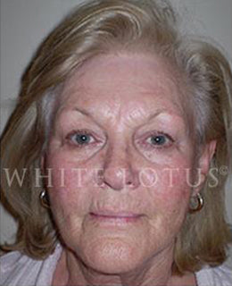 Wrinkles and Sun Damage Before