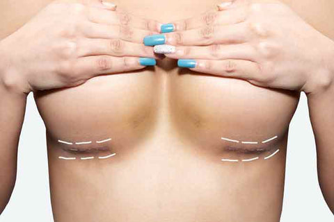 microneedling breast scars