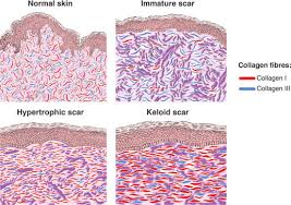 How long does it take to see results from microneedling