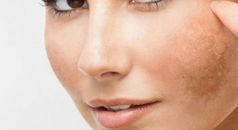 skin needling for melasma