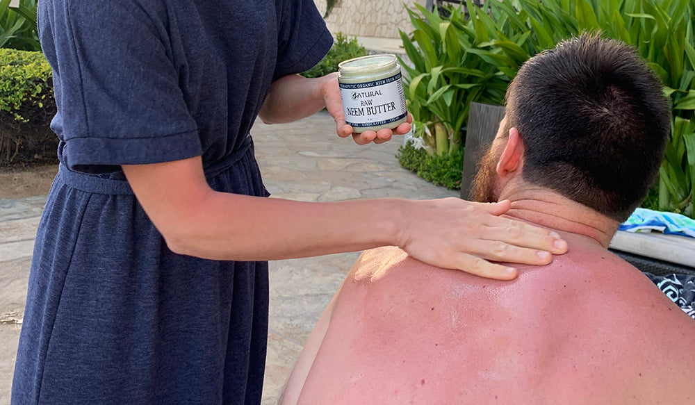 Man with sunburn applying Zatural Neem Butter