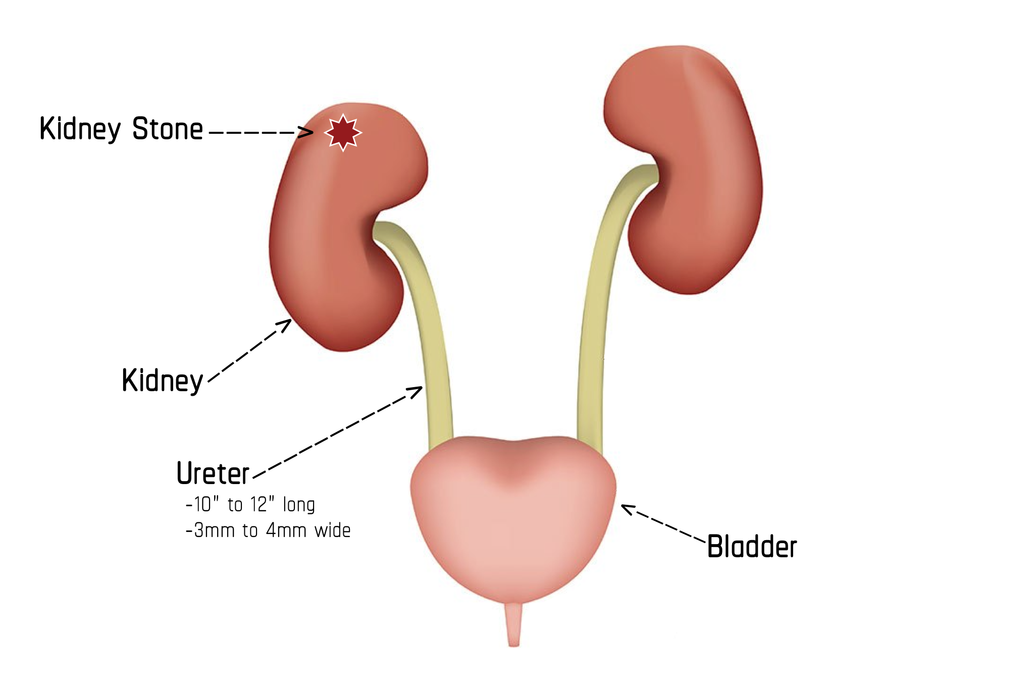 passing a kidney stone